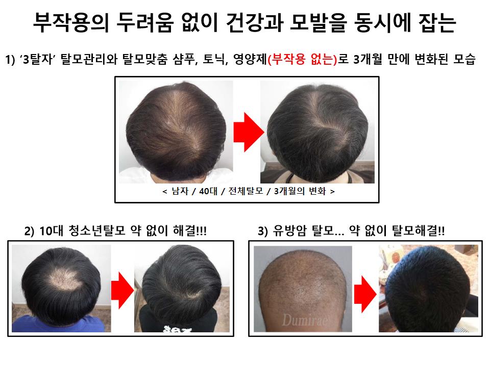 부작용 없이 탈모 해결